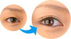 Eyelid